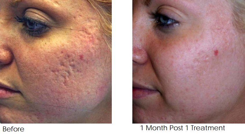 acne-scar-removal-treatment-melbourne-after-1-treatment