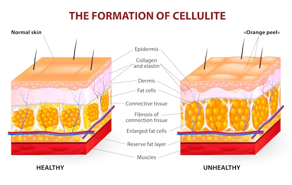 The Reason Why Liposuction Is Not A Treatment For Cellulite Feel Good