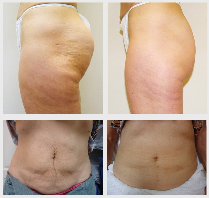 How to choose the best cellulite / skin tightening treatment