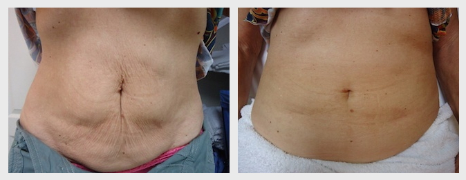 Stomach Tightening: Laser Skin Tightening Treatment