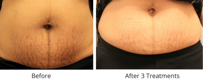 Stretch Mark Removal Melbourne - SPECIALIST Treatment | 1300 896 834